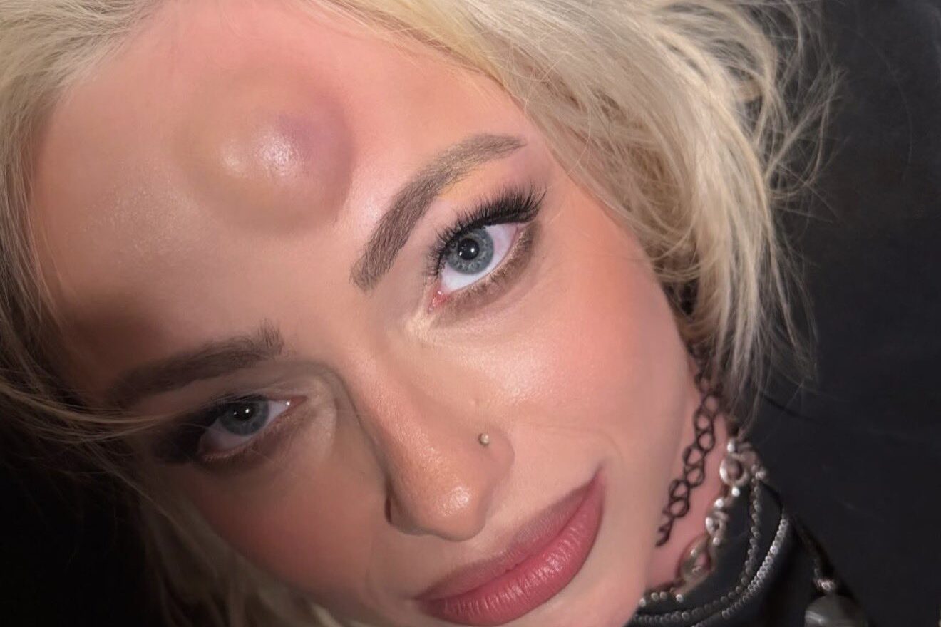 Liv Morgan Details Treatment For Hematoma Caused By Head Clash With Roxanne Perez